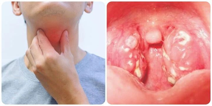 Bệnh bạch hầu - Triệu chứng nhận biết bệnh bạch hầu