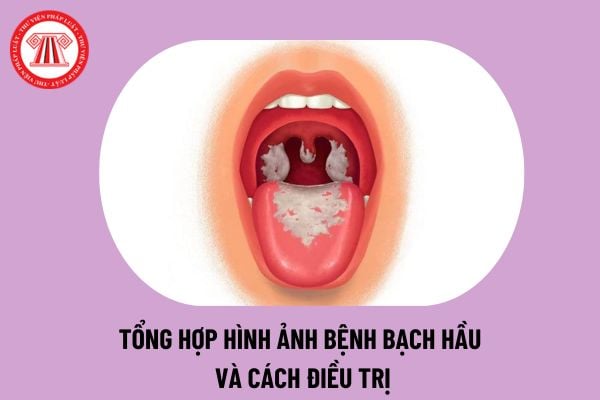 Bệnh bạch hầu - Chẩn đoán và điều trị bệnh bạch hầu