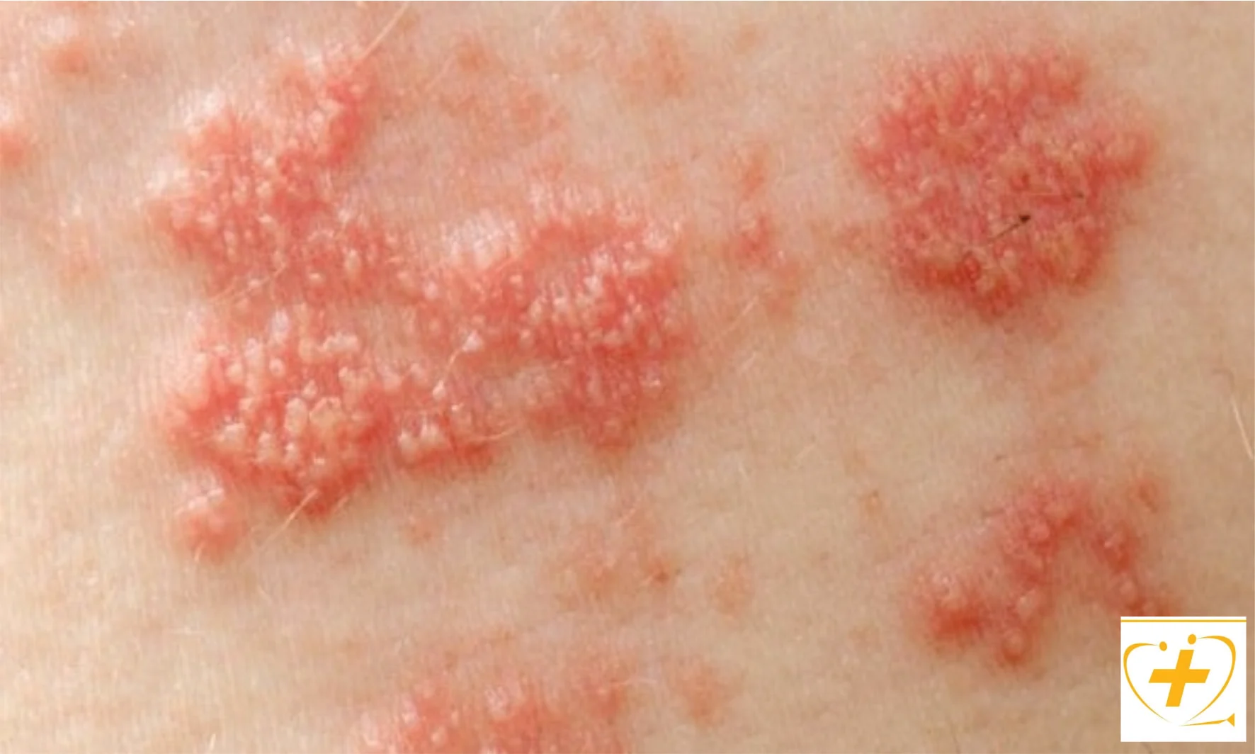 Zona thần kinh - 2. Biến chứng ở mắt và tai